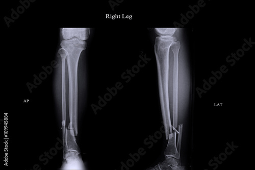 closed fracture left leg tibia and fibula