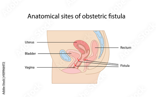 Anatomical sites of obstetric fistula diagram photo