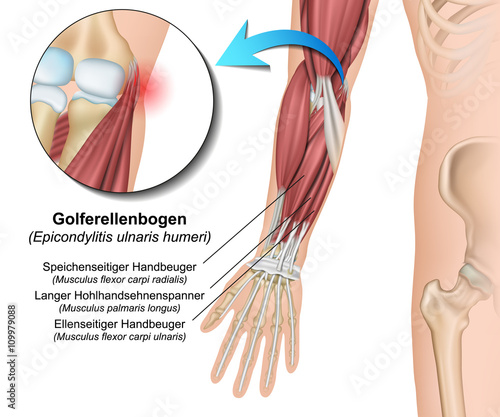 Epicondylitis, Golferellenbogen