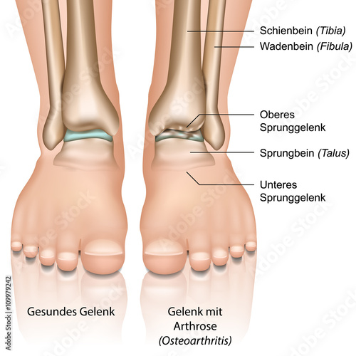 Arthrose im Sprunggelenk