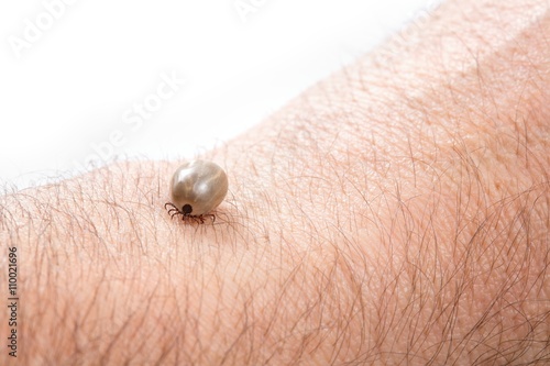 Tick sucked blood on human skin