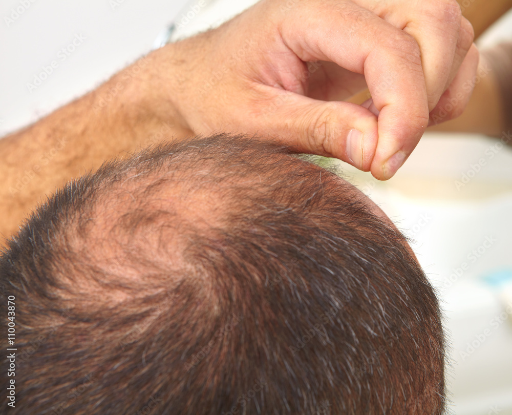 Senior man and hair loss issue Senior man and hair loss issue