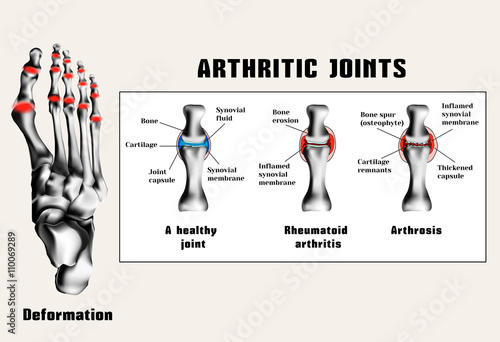 Arthritic joins (rheumatoid arthritis, arthrosis (osteoarthritis)).The disease of the joints.