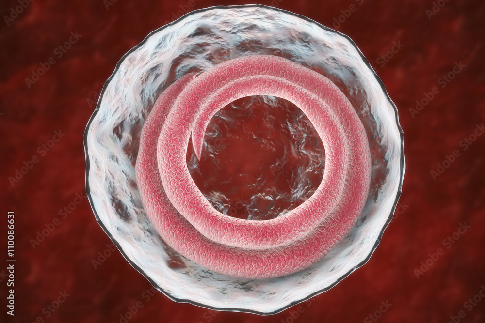 Cyst containing roundworm Trichina spiralis (formely called Trichinella