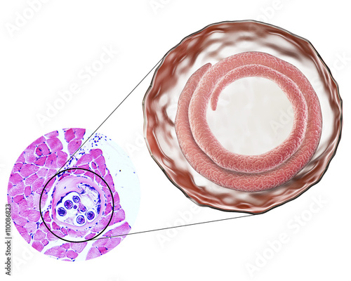 3D illustration and micrograph (transverse section) of cyst in muscle containing helminth Trichinella spiralis, nematode larval cyst in muscle tissue, transmitted by ingestion of undercooked meat photo