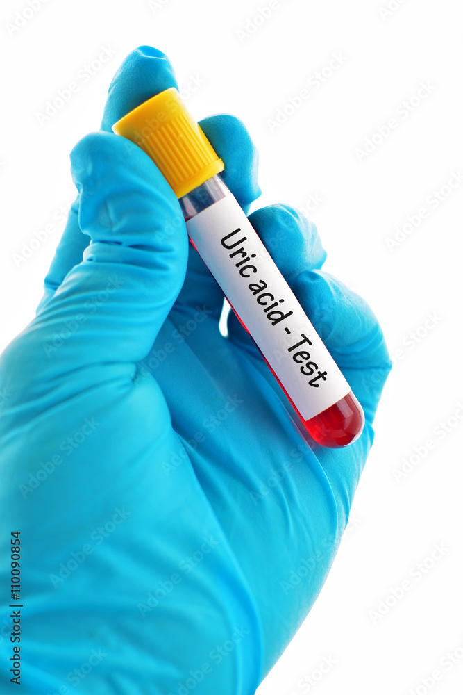 Obraz premium Blood sample for uric acid test, gouty arthritis diagnosis 