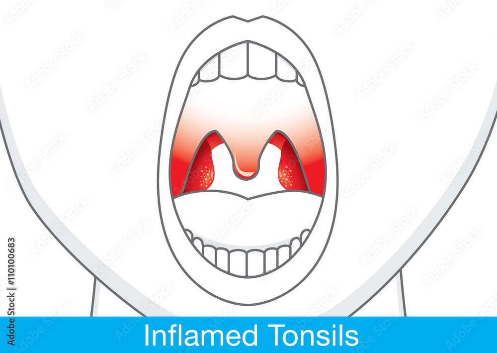 Showing Inflamed tonsils by open mouth. This illustration about health and medical.