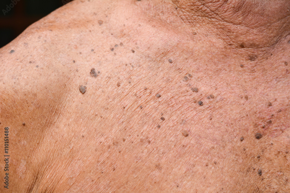 Fototapeta premium Moles on the body
