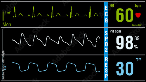 Patient monitor displays vital signs ECG electrocardiogram EKG, oxygen saturation SPO2 and respiration. Medical examination vector illustration. photo