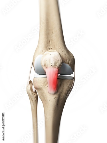 Inflamed patellar tendon, artwork photo