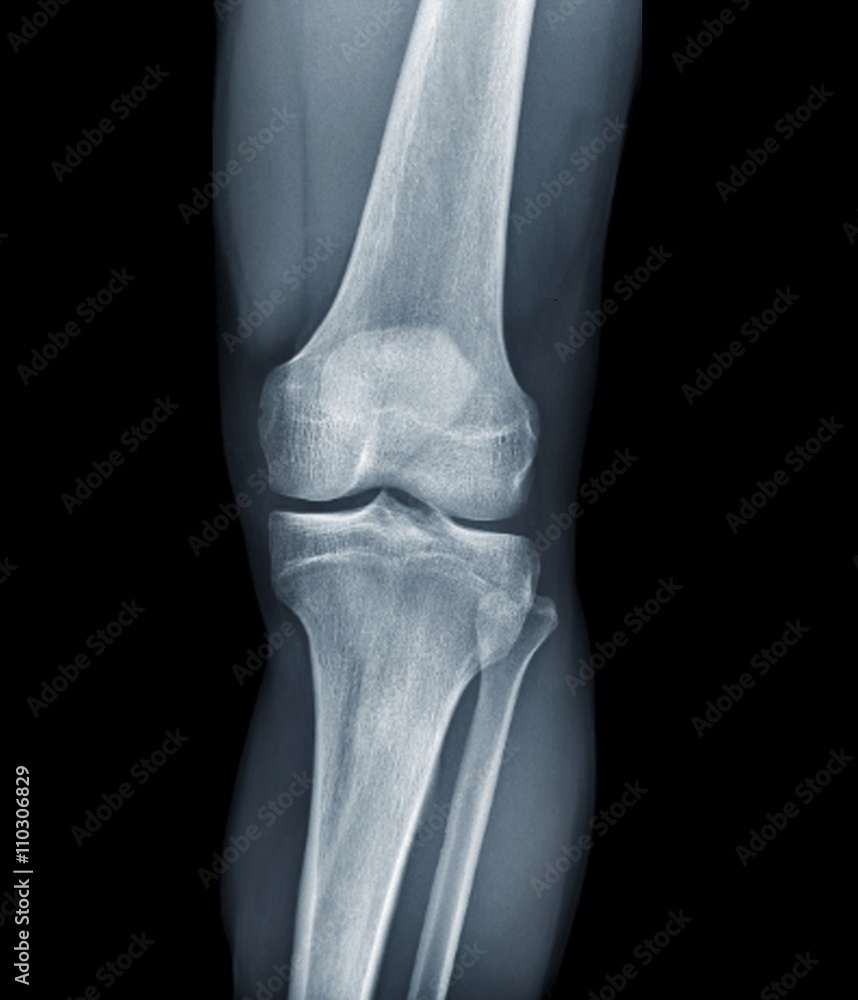 Normal knee, Xrays Stock Photo Adobe Stock