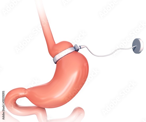 Human gastric band, illustration