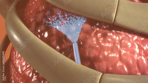 Quadro em tela Lung tumour
