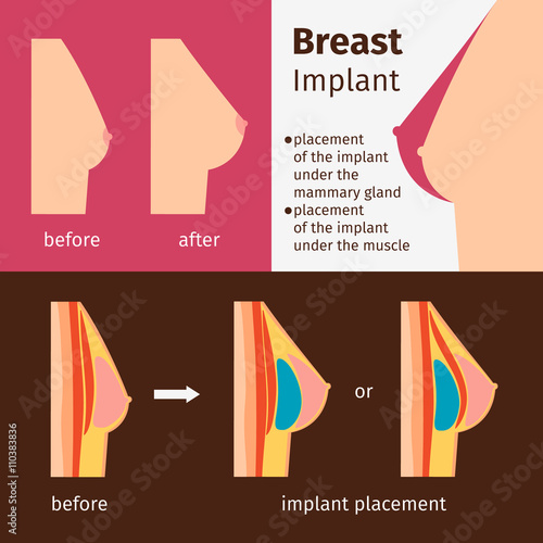 Breast augmentation infographics. Breast implants vector illustration photo