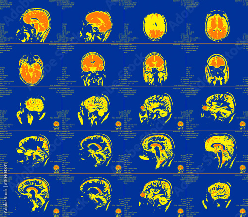 Magnetic resonance imaging of the brain 