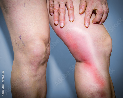 Thrombophlebitis in human leg photo