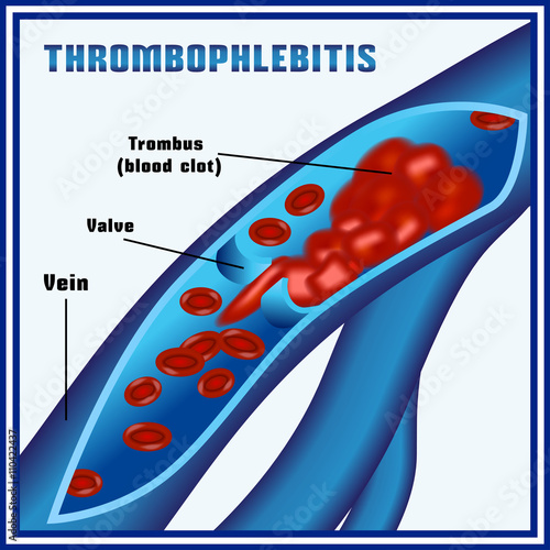 Thrombophlebitis, blood clots in the veins. Embolism. Thrombosis.  Phlebothrombosis.