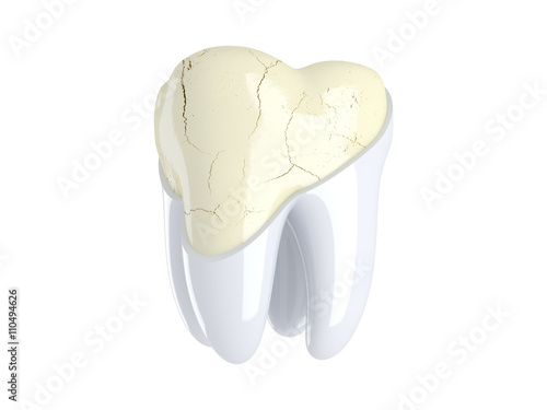 Vászonkép Cracks in the tooth. 3D render