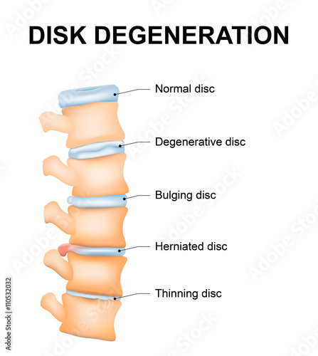 Disc degeneration