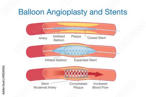 Balloon angioplasty and stents procedure for heart disease treatment. This illustration about medical. photo