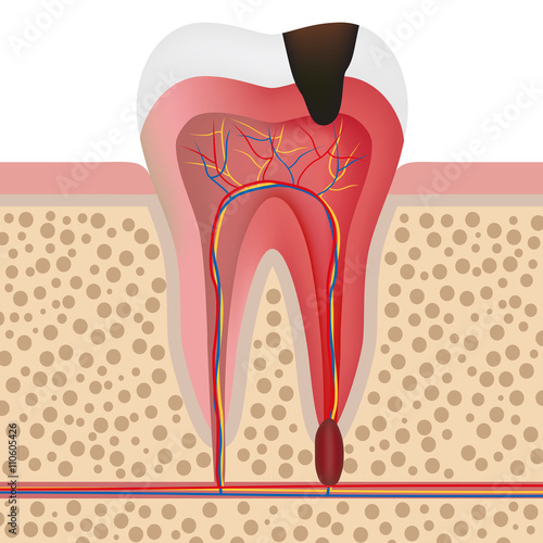 Illustration of infected tooth