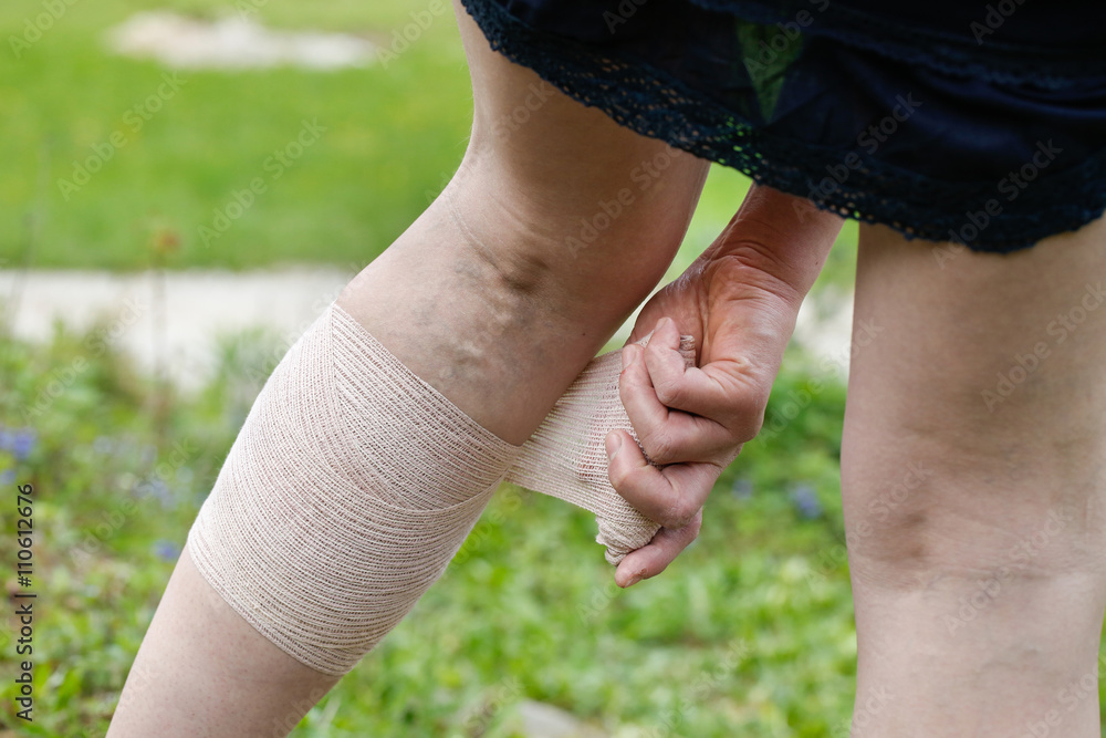 Woman with varicose veins applying compression bandage