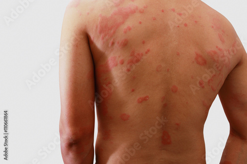 Man with dermatitis problem of rash ,Allergy rash photo