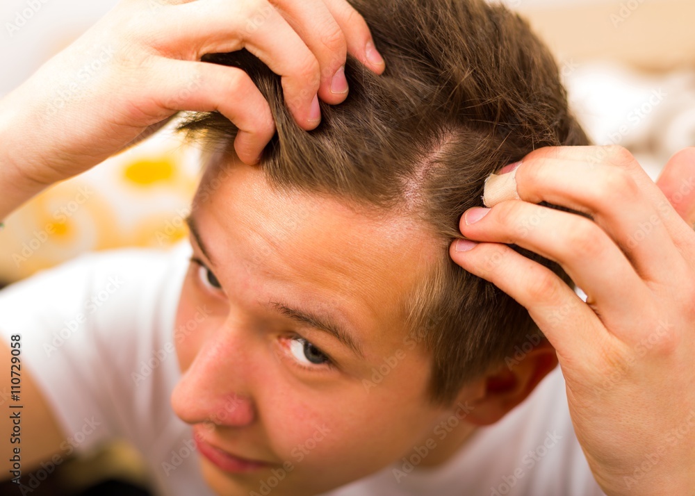 Naklejka premium Hair loss comes even in youth