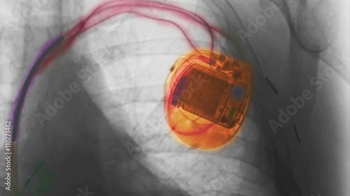 Computer animation of pacemaker photo