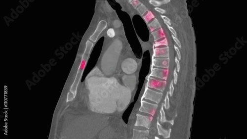 Metastatic lesions to spine