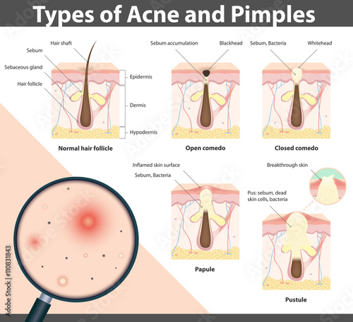 Types of Acne and Pimples, vector illustration