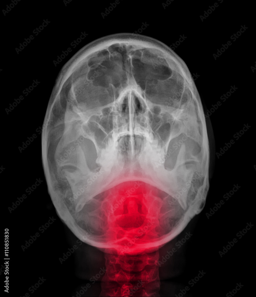skull x-rays image sagital plane skull x-rays image sagital plane