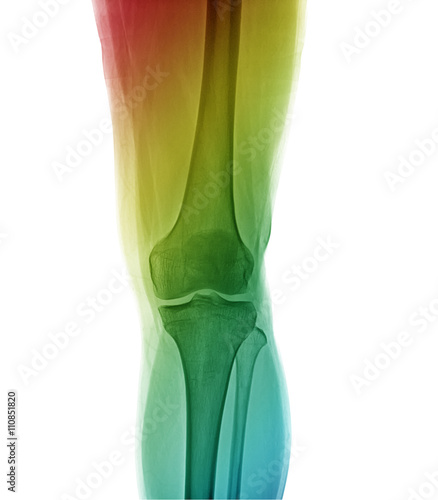 Right knee joint X-ray photos  the front position