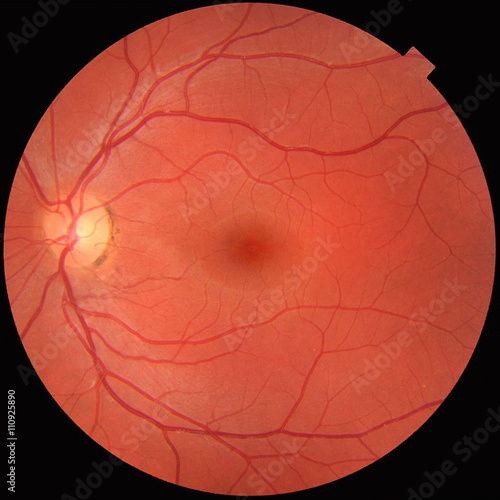 Fundus photograph of a normal left eye. Macula in center and optic disk where blood vessels converge with pigmentation on perimeter