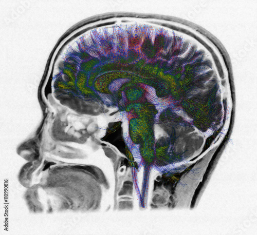 Diffusion MRI, also referred to as diffusion tensor imaging or DTI, of the human brain