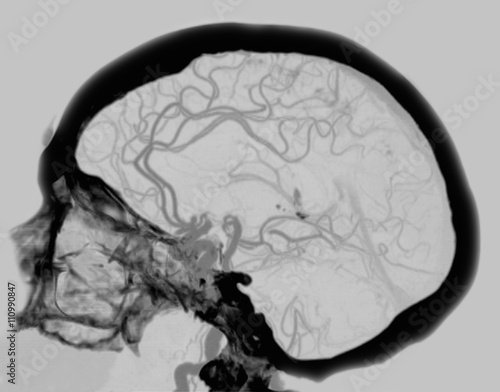 Angiogram CT showing the blood supply of the brain, including the Circle of Willis photo