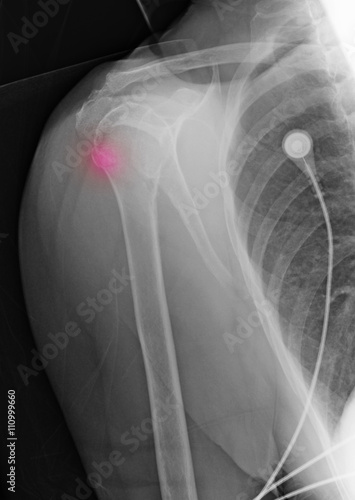 88 year old female with upper humerus fracture, and history of osteoporosis