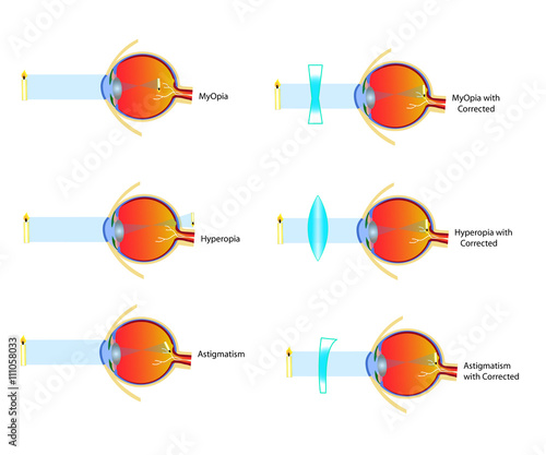 Astigmatism, Myopia and Hyperopia