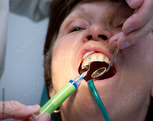 Dentist working on teeth photo