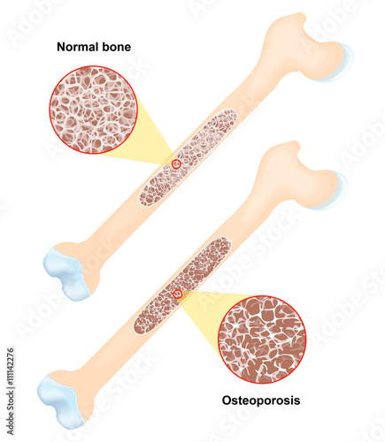 Osteoporosis. disease of bones