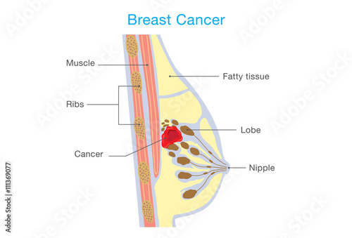Growth of breast cancer cell in woman.This illustration about medical. side view.