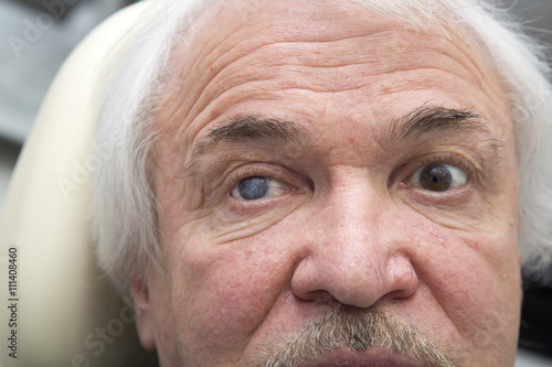 Portrait of elderly man with eye disease