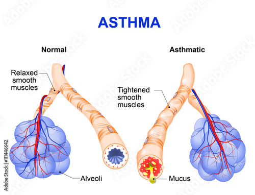 inflamation of the bronchus causing asthma photo