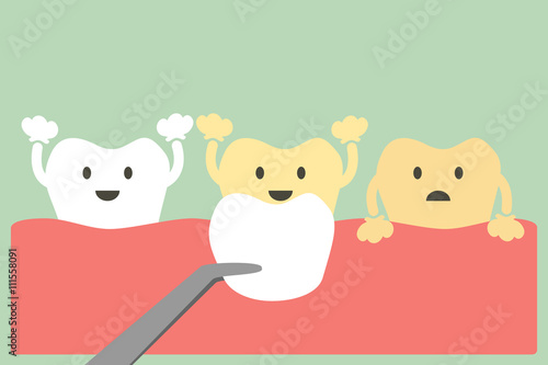 veneers teeth