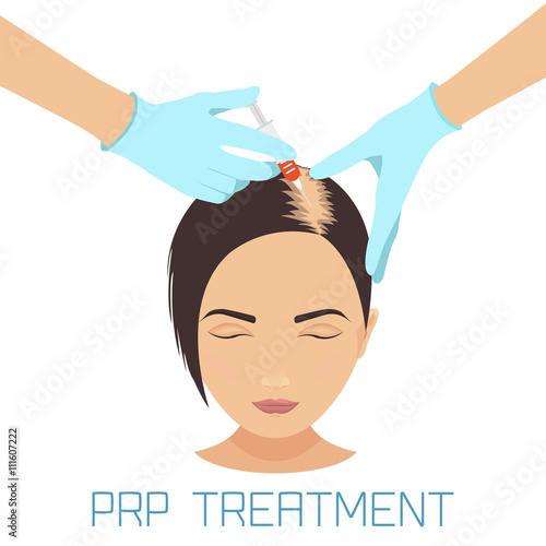 Platelet rich plasma injection procedure. PRP therapy process. Female hair loss treatment infographics. Meso therapy. Hair growth stimulation. Vector illustration.