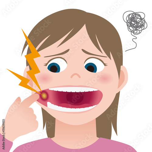 mouth ulcer, inflammation of the oral mucosa, image illustration