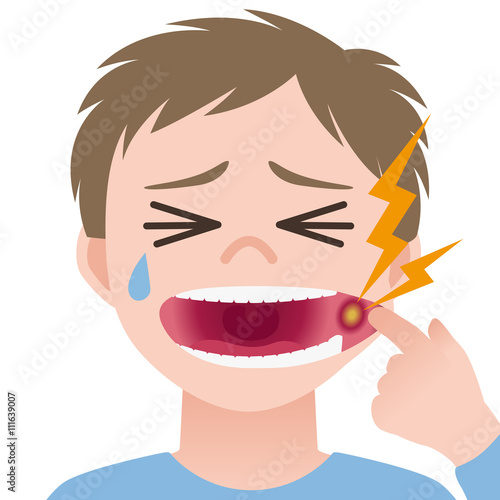 mouth ulcer, inflammation of the oral mucosa, image illustration