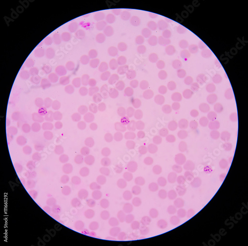 blood films for Malaria parasite.showing pink cells malaria pigm photo