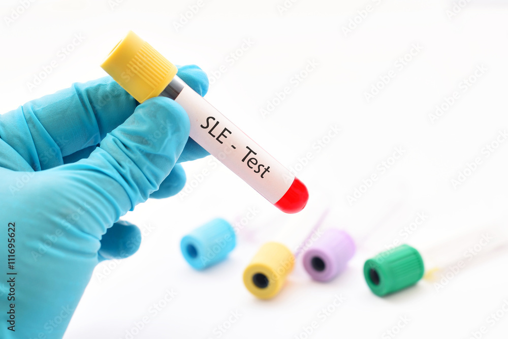 Blood sample for systemic lupus erythematosus (SLE) test Stock Photo