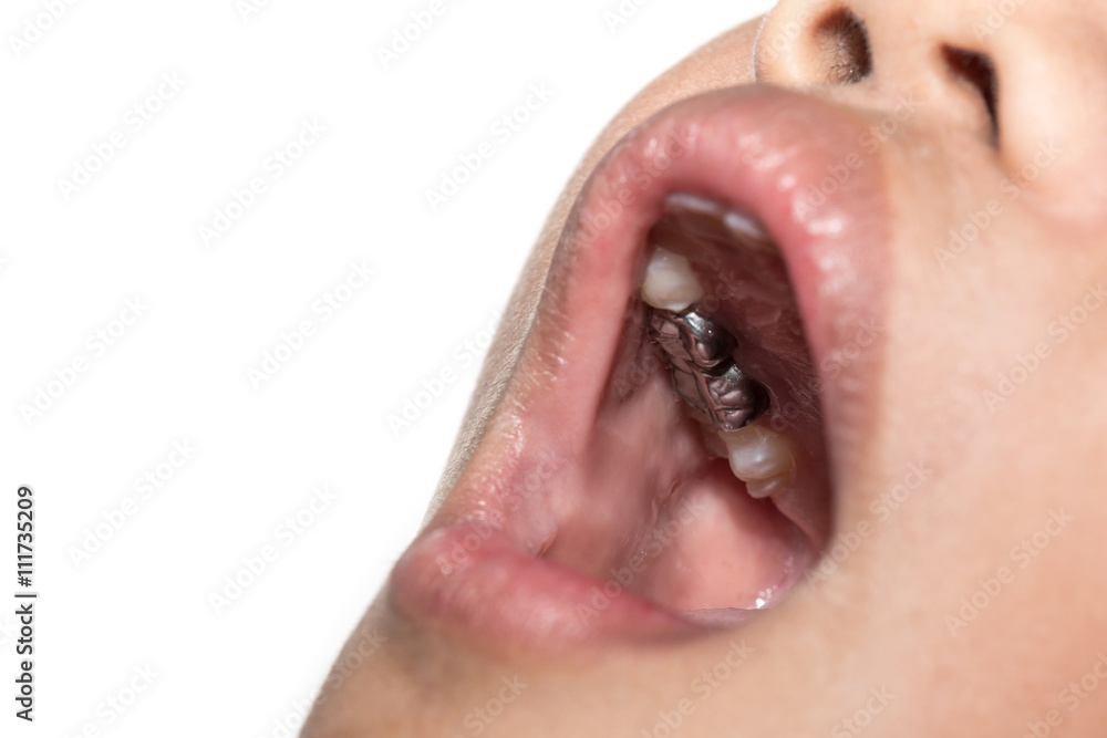 Fototapeta premium Children with a mouthful of metal dental crowns
